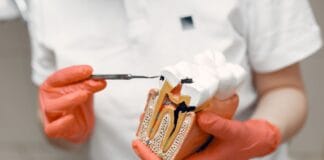 Dentysta trzyma model zęba, ilustrując leczenie kanałowe